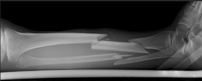 Senior Bailey Kluksdal’s family pranked their mom by showing a fake x-ray of her freshman sister’s “broken leg.” No leg was broken, no harm was done, except for the despair of the April Fool’s Day joke.